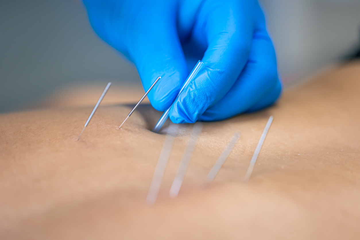 Dry needling 